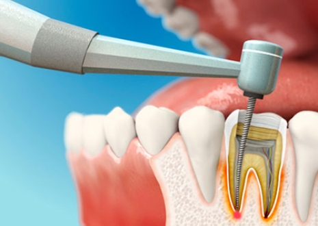 ĐIỀU TRỊ TỦY